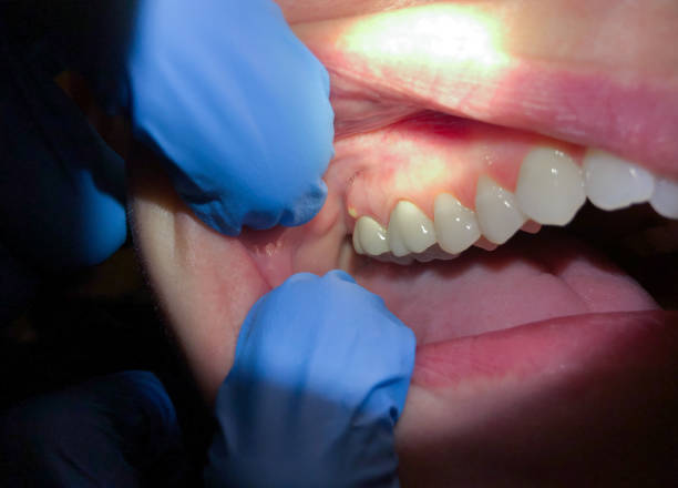 Best Broken or Chipped Tooth Repair in Fayetteville, AR