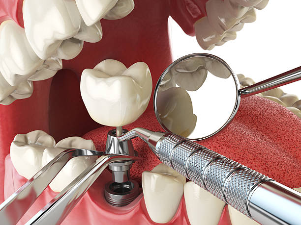 Best Dental Abscess Treatment in Fayetteville, AR